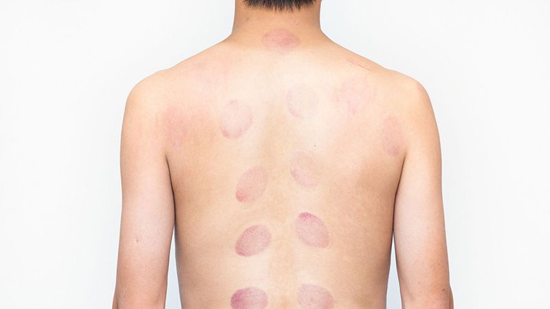 rond rouge cupping